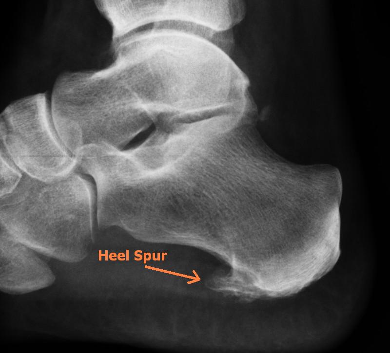 Causes of Heel Pain not Plantar Fasciitis — Valley Stream Podiatry